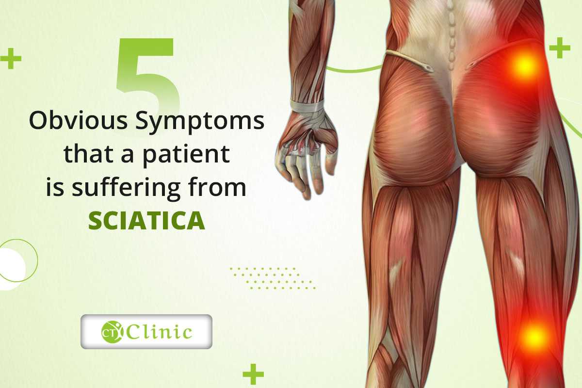 5 Obvious Symptoms That a Patient Is Suffering From Sciatica